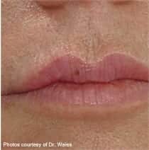 Female lips, after Deep FX treatment, front view - patient 2