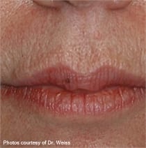 Female lips, before Deep FX treatment, front view - patient 2