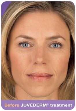 Woman's face, before Juvederm treatment, patient 2