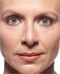 Woman's face, before Juvederm treatment, patient 4