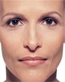 Woman's face, after Juvederm treatment, front view, patient 3