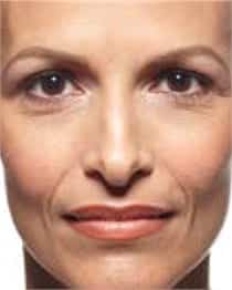 Woman's face, before Juvederm treatment, front view, patient 3