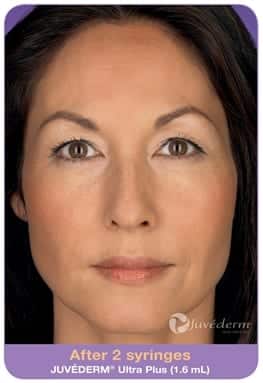 Woman's face, After 2 syringes Juvederm Ultra Plus (1,6 ml), patient 1