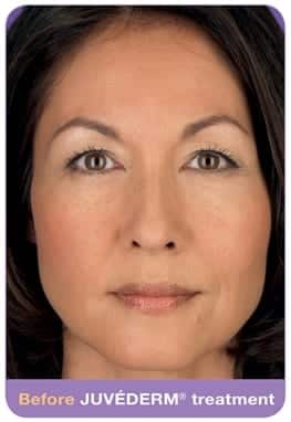 Woman's face, before Juvederm treatment, patient 1