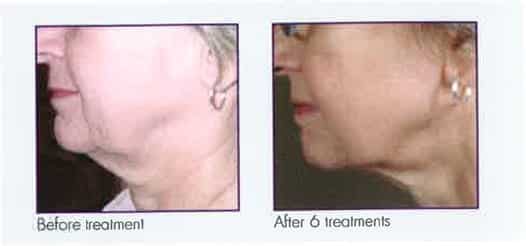 Female face, before and after 6 Microneedling treatments, side view, patient 1