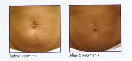 Female abdomen, before and after 6 Microneedling treatments, front view, patient 4