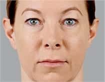Woman's face, after Voluma® treatment, front view, patient 2