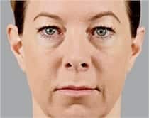 Woman's face, before Voluma® treatment, front view, patient 2