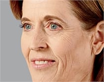 Woman's face, after Voluma® treatment, side view, patient 1