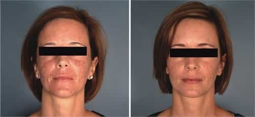 Woman face, before and after ActiveFX® treatment, front view, patient 1