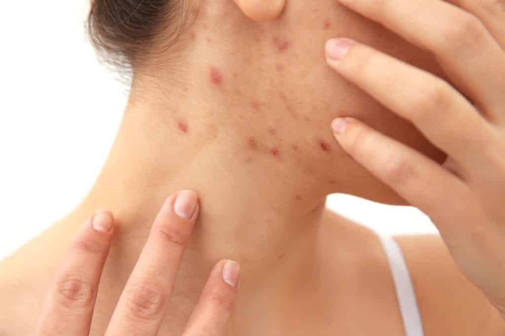 Our Approach to Effective Acne Treatments