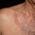 berloque_dermatitis