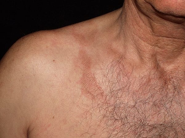 berloque_dermatitis