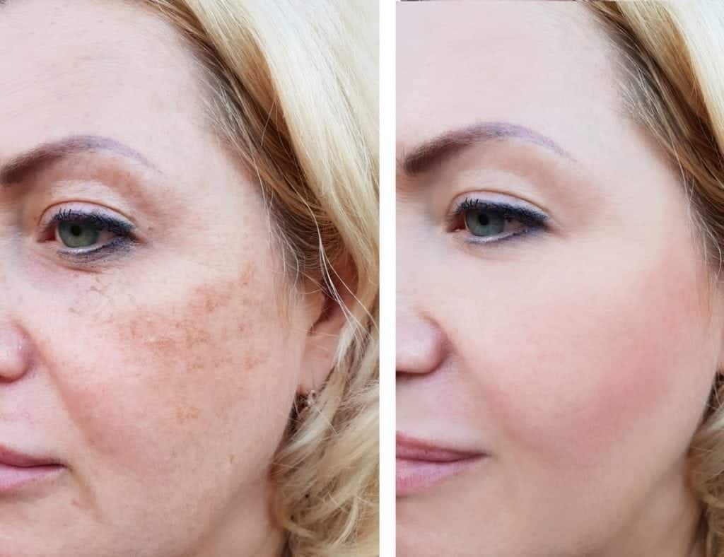 Gendler Dermatology - before and after Fraxel