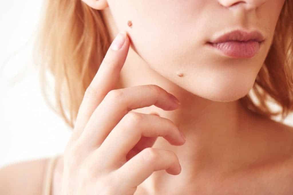 What You Need to Know About Moles