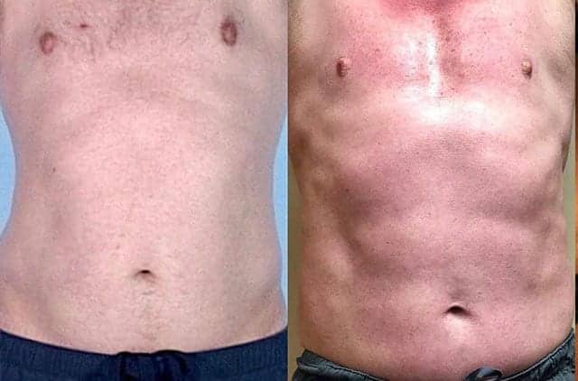 Male body (abdomen), before and after Emsculpting treatment, front view, patient 2