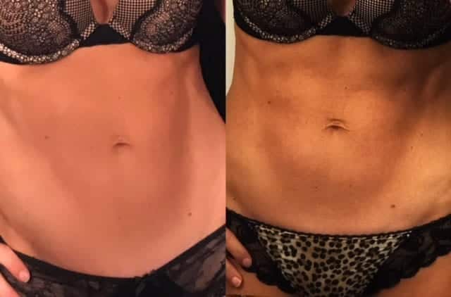 Woman's body (abdomen), before and after Emsculpting treatment, front view, patient 1