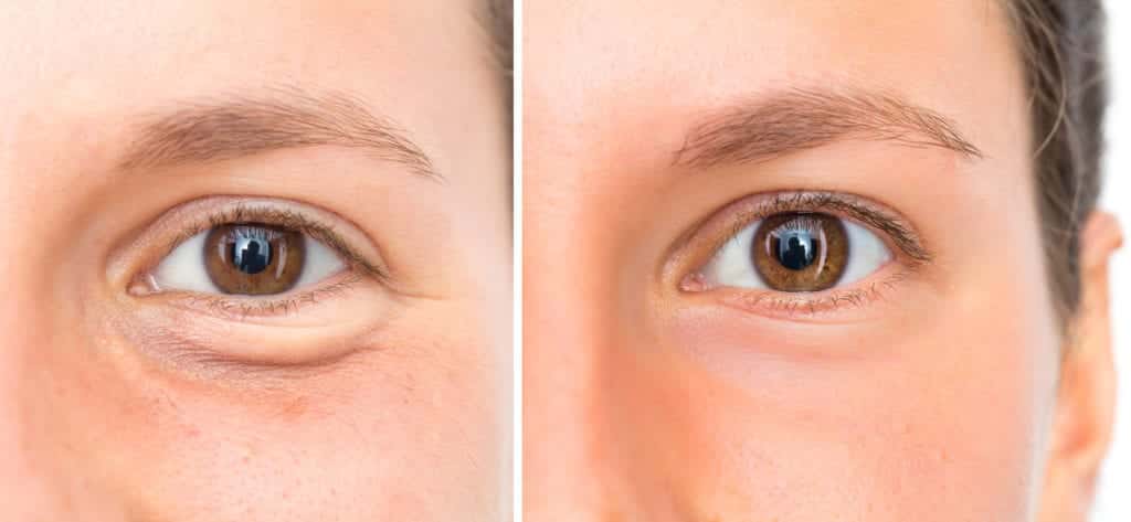 Before and after clear and brilliant laser treatment