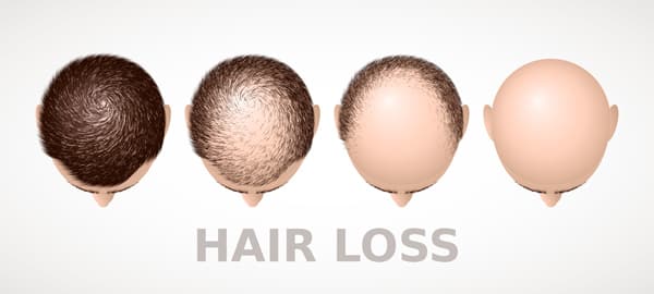 Male pattern baldness