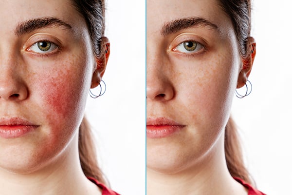 Woman's face, before and after rosacea treatment, front view