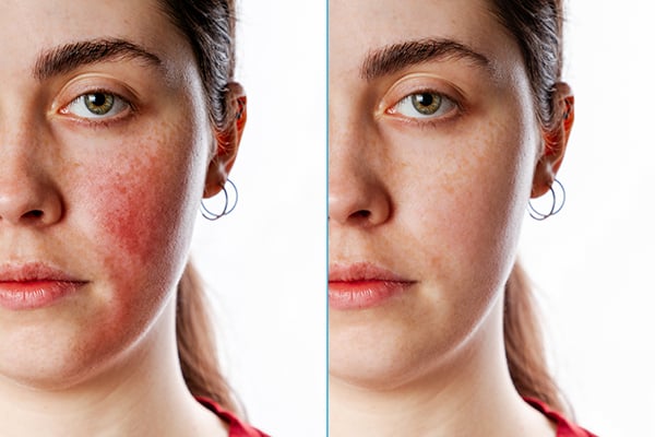 acne rosacea before after