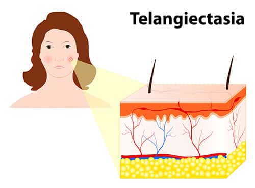 Telangiectasias