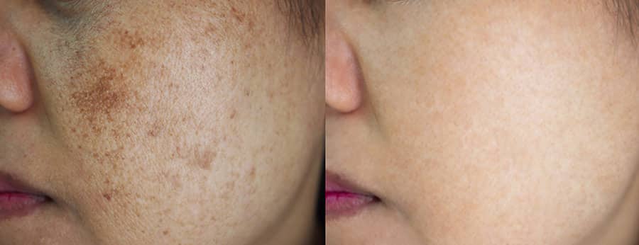 Woman's face, before and after Melasma treatment, oblique view