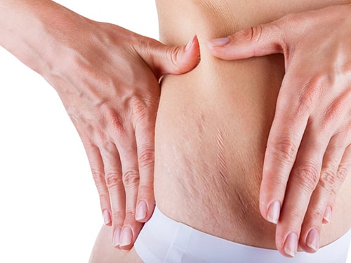 Stretch Marks (Striae) Treatments