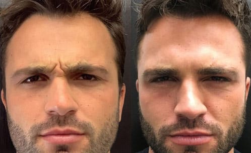 Male face, before and after Botox treatment, patient 1