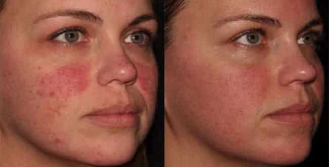 Woman's face, before and after BroadBand Light treatments, patient 2