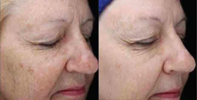 Woman's face, before and after BroadBand Light treatments, patient 3