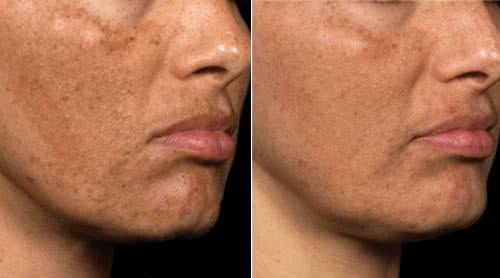 Woman's face, before and after Fraxel treatments, patient 2