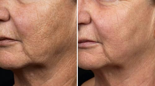 Woman's face, before and after Fraxel treatments, patient 3