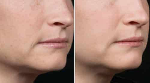 Woman's face, before and after Fraxel treatments, patient 4