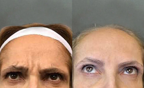 Woman's face, before and after Botox treatment, patient 1